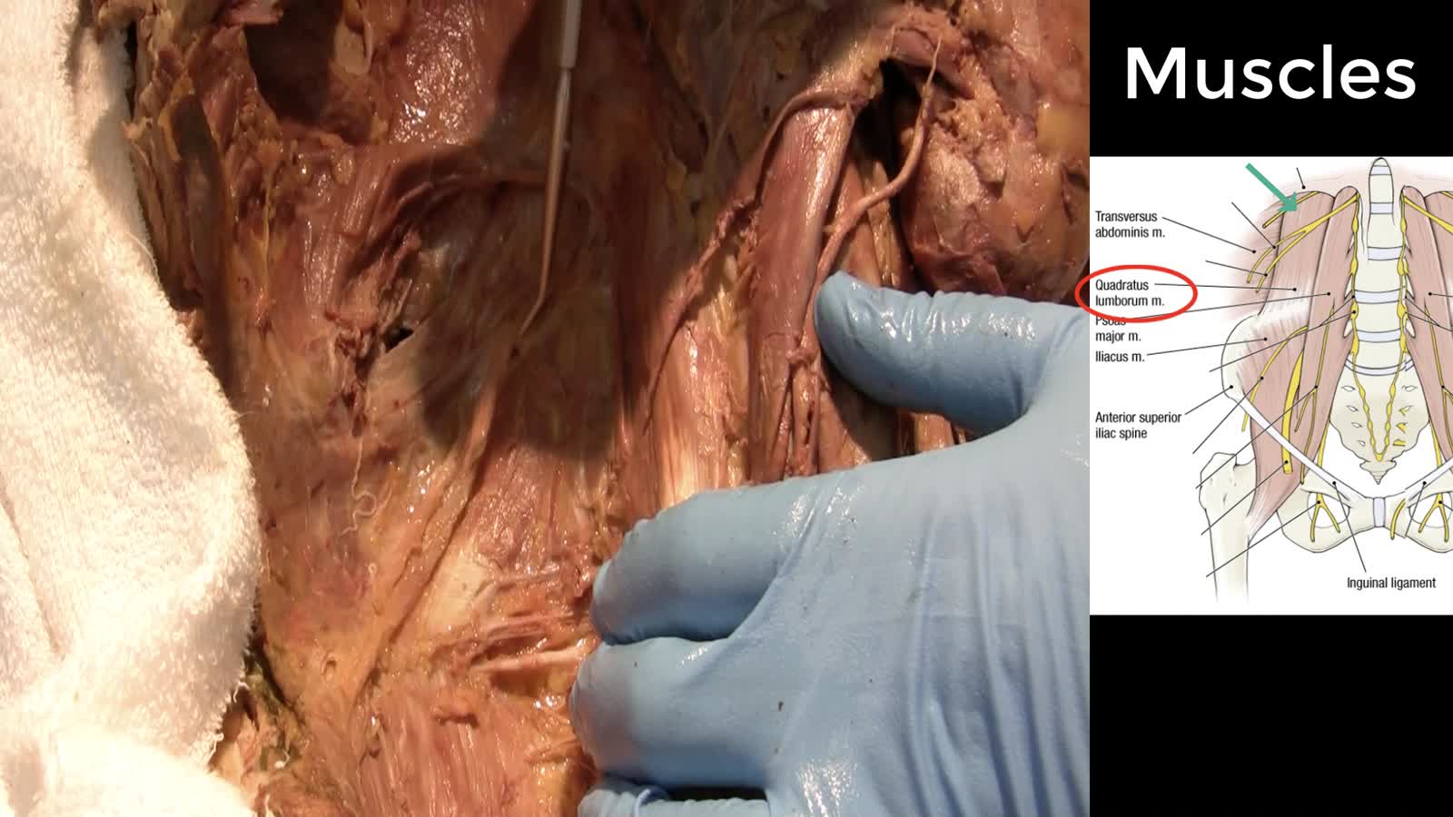 AP4 Posterior Abdominal Wall